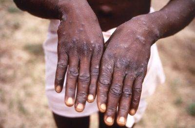 Hands with Monkeypox Lesions